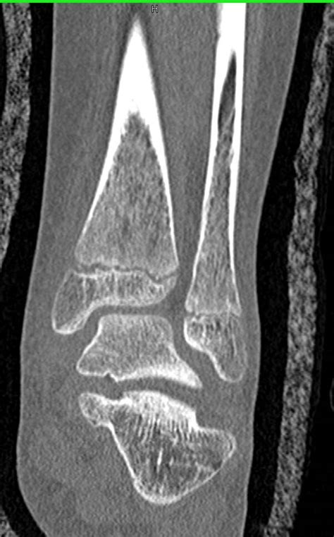 Tibial Fracture Thru The Epiphyseal Plate Pediatric Case Studies