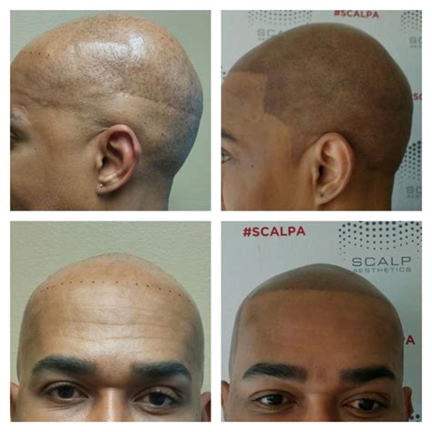 Scalp Micropigmentation Scalp Tattoo And Hair Tattoo At Scalp
