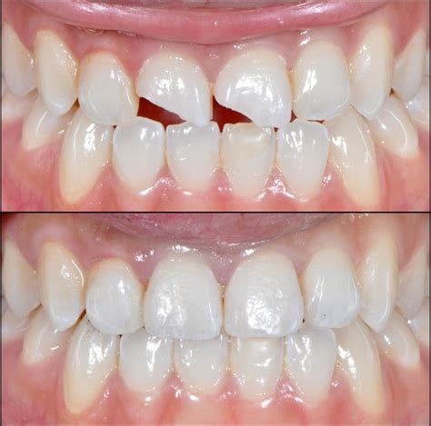 Cómo aplicar técnicas de estratificación en resinas para odontología Dentalnader