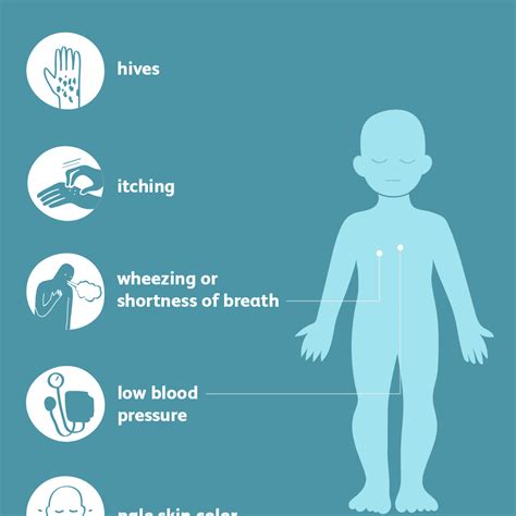 Anaphylaxis Signs Symptoms And Complications