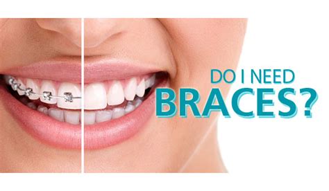 All About Juan How To Know If You Need Braces
