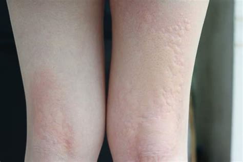 Myths And Facts About Chronic Hives