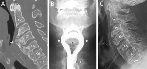 Cureus Symptomatic Anterior Cervical Osteophyte Causing Dysphagia