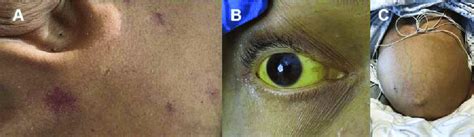 Clinical Features Of Cirrhosis A Spider Nevi B Severe Scleral