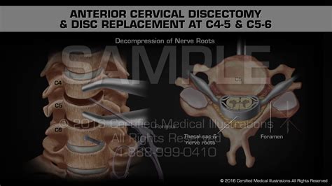 Anterior Cervical Disc Replacement Vs Discectomy Fusion Tw