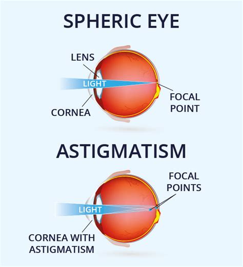 What Is Astigmatism Vision Direct Uk