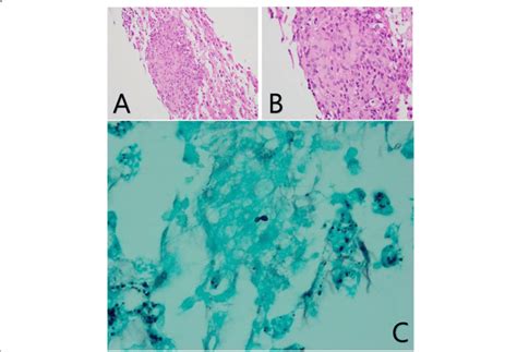 Histology Of Histoplasma Var Capsulatum A Hande Stain On 20x