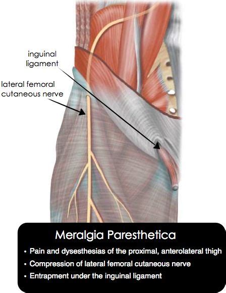 Meralgia Paresthetica Also Known As Lateral Femoral Cutaneous Nerve