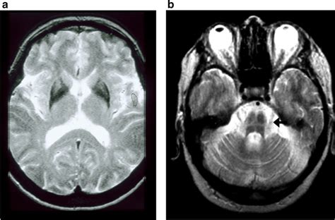 A T2 Weighted Mri Showing A Low Lateral Putamen Signal At The Same