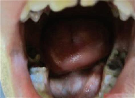 Swelling On Floor Of Mouth Under Tongue Treatment