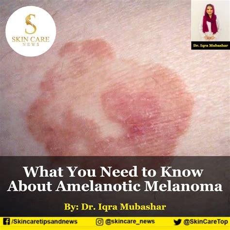 What You Need To Know About Amelanotic Melanoma