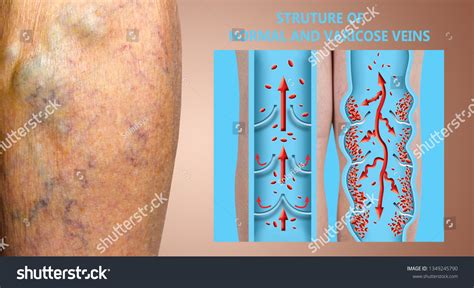 Varicose Veins On Female Senior Legs Stock Photo 1349245790 Shutterstock