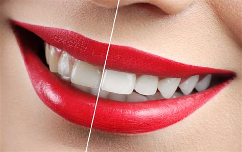 Show Off Your Bright Smile With Teeth Whitening Here Are 6 Benefits