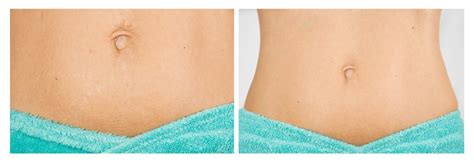 microneedling for stretch marks a minimally invasive treatment