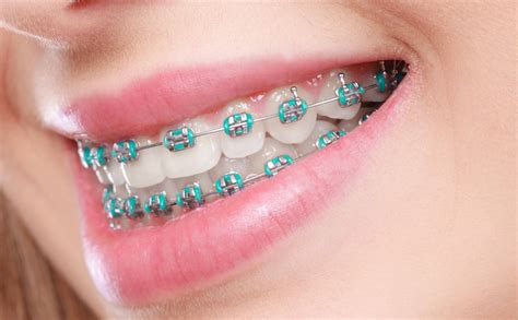 Types Of Dental Braces For Adults Voss Dental Houston Tx