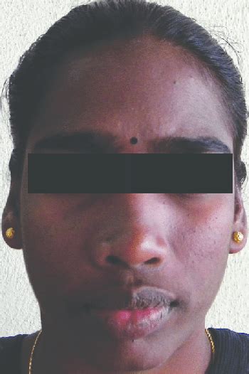Extraoral Photograph Showing Diffuse Swelling Of The Right Middle‑third