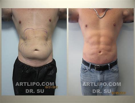 Male High Definition Abdomen Tampa Six Pack Abs Tummy Liposuction Florida