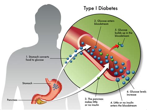 We'll also explore the causes and risk factors of type 2 diabetes, as well as what you can do to prevent, treat, and reverse type 2 diabetes completely. Liraglutide Benefits Patients With Type 1 Diabetes