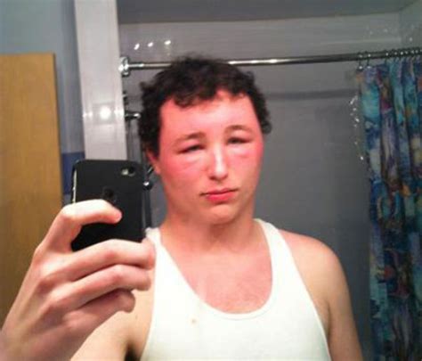 The Mad Effects Of Bee Stings On Faces 19 Pics