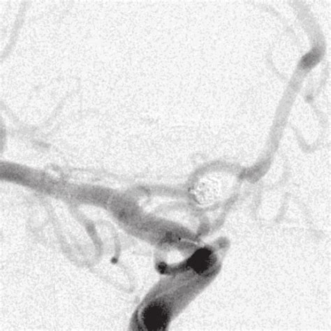 Pdf Ruptured Cerebral Aneurysm Of Fenestrated A1 Segment Of The