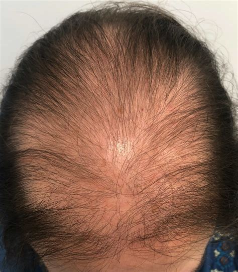 Las Mujeres También Sufren La Alopecia Estos Son Los Mejores Tratamientos