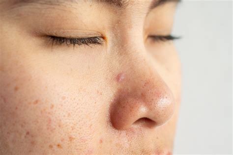 Nose Acne A Top Dermatologist Answers Your Questions Glamour Uk
