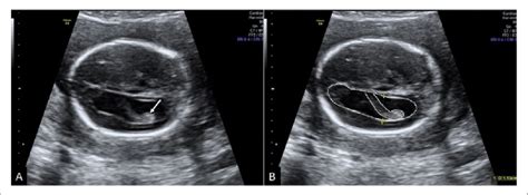 Fetal Ventriculomegaly A Mild Ventricular Dilatation With A Dangling