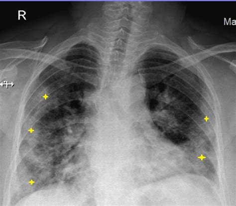 Pneumonia Chest X Ray Findings Tatakm