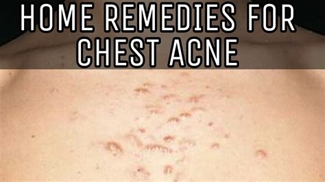 Home Remedies For Chest Acne Youtube