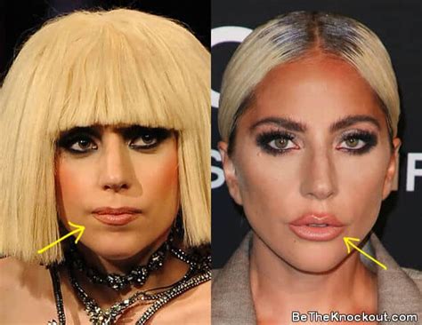 Lady Gaga Plastic Surgery Comparison Photos