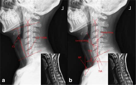 Characteristics Of Cervical Sagittal Parameters In Healthy Cervical