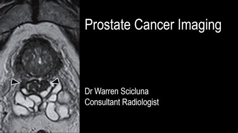 Prostate Cancer Imaging Youtube