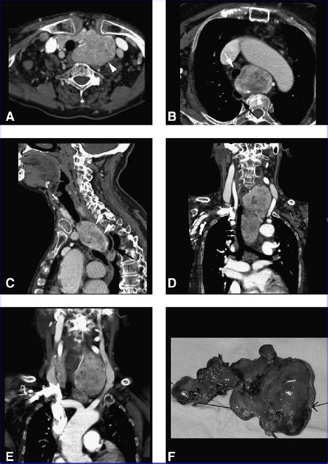 Left Retrosternal Goiter Axial Scans A B Sagittal Scan C