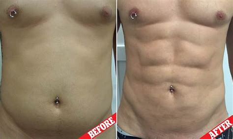 Men Turn To 8000 Vaser Liposuction To Get A Six Pack Daily Mail Online