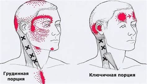 Карта триггеров точки боли и точки напряжения мышц Триггерные точки