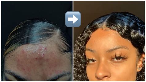 Skin Care Routine How I Cleared Up My Acne Prone Skin Youtube