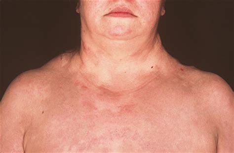 Angioedema Eosinophilia And Fever—quiz Case Allergy And Clinical