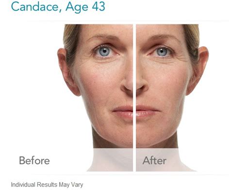 Radiesse Dermal Filler Before And After Photos Houston The Woodlands