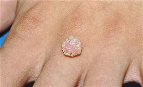 Photos Of Warts On Hands And Fingers How To Remove Moles Warts Skin