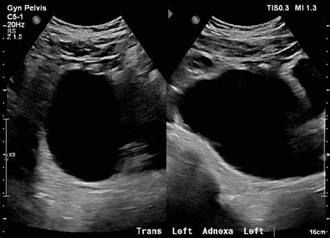 Cureus Left Ovarian Cyst With Overlying Sigmoid Colon