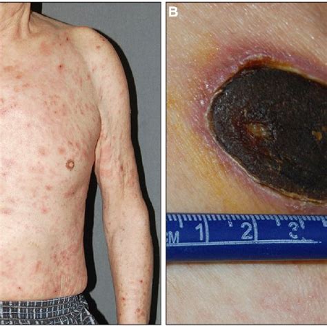 A Clinical Photographs Of Initial Angioimmunoblastic T Cell Lymphoma