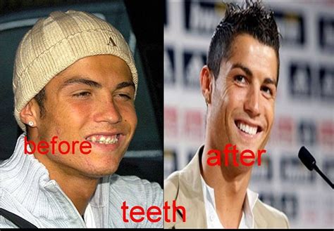 Cristiano Ronaldo Teeth Before And After