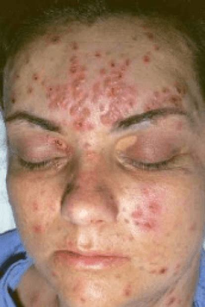 Shingles On Face Causes Symptoms Red Painful Bumps Blisters