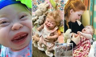 Rare I Cell Disease Will Kill Seattle Girl By Three Daily Mail Online