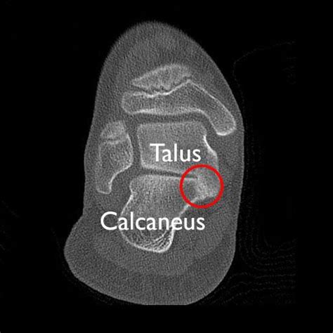 Tarsal Coalition Orthoinfo Aaos