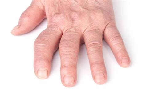 Osteoarthritis Deformans Symptoms And Treatment Hondrogel