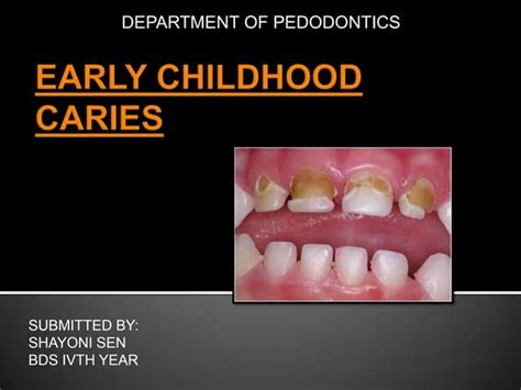 Early Childhood Caries Ppt