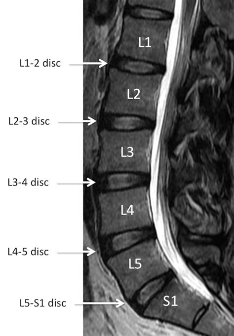 Mri Lumbar Spine Anatomy Rocky Mountain Brain And Spine Institute