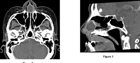 Figure 3 From A Nasal Septal Abscess Semantic Scholar