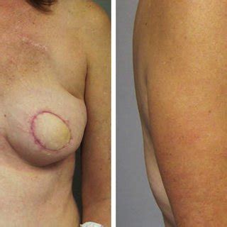 The Patient After A Bilateral Skin Sparing Mastectomy And Immediate